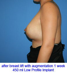 plastic-surgery-breast-lift-augmentation